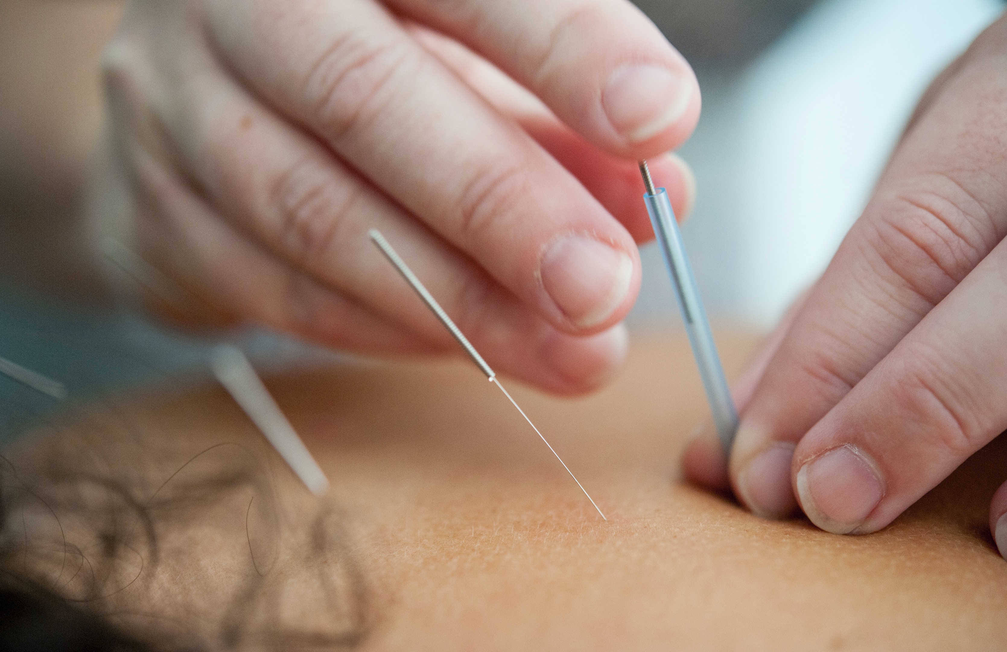 Acupuncture: TCM's Ancient Solution for Modern Pain Challenges