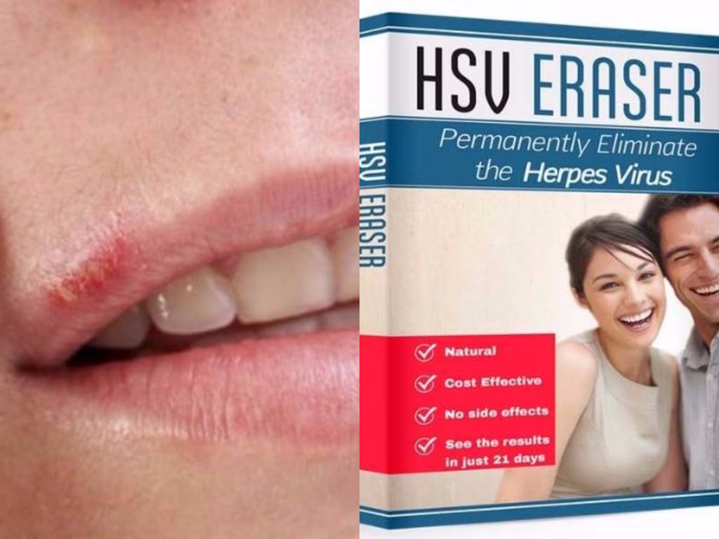The HSV Eraser Within the Us A Spotlight On Successful Methods