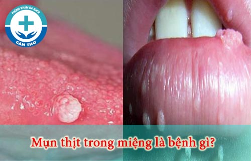 Mụn thịt trong miệng là bệnh gì? Cách chữa như thế nào?