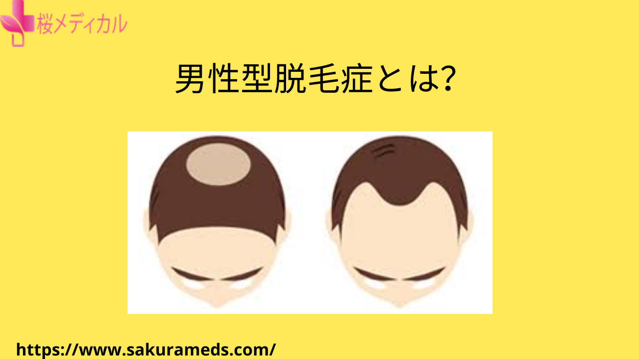 男性型脱毛症とは？